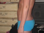 night before surgery. full side!
