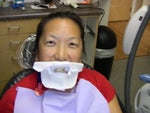 before zoom whitening - the shielding