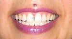after zoom whitening