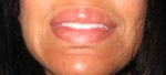 note nodules