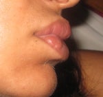 note nodules on sides