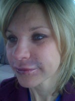 DAY AFTER INJ