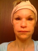 MOST RECENT 1 MO PAST INJ