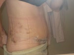 2 weeks after surgery, the lines are from the binder not the surgery