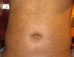 day 15///Swelling flare up!