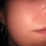 check photo.  scars are not as noticable on camera
