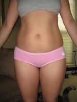 before smart lipo