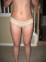 5 days after smart lipo