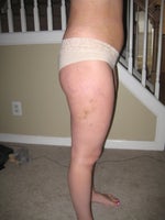 5 days after-small bruise and some swelling