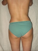 After pic - 5 weeks out My flanks look flabby and my right thigh has a lump on it