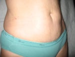 After pic - 5 weeks notice the lump