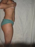 After pic - 5 weeks out side view notice the flab -- no tightening yet