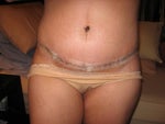 Post Tummy Tuck - Day 12