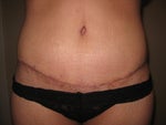 Post TT Week 5 Day 2, First good look at my scar without tape.