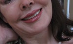 after permanent lip augmentation