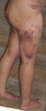 mommy makeover post op flanks