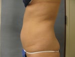 before pic, took on 2/18, side