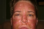This was taken on day 4 after I applied the peel..notice the eye swelling
