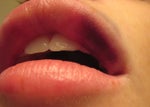 Upper lip bruising