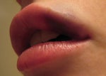 Upper lip bruising