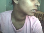 two weeks post op. profile.