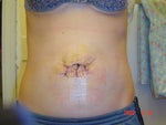 4 days post-op