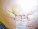 6 days post-op
