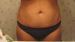 Before: The night before surgery