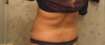 Before: Flanks