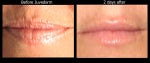No more prune lips after 1 syringe of Juvederm!!!