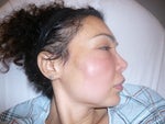 Me before surgery to open the abscess