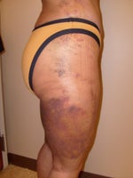 Thighs after 1 week