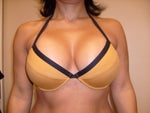 1week after augment and swollen