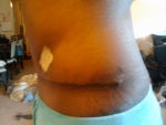 Left side 3wks PO