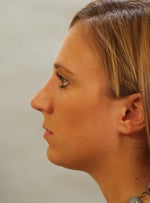 After my Nose Surgery & Chin Implant
