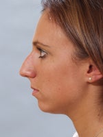 Before my Nose Surgery & Chin Implant