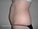 Side shot after session 2 of lipodissolve