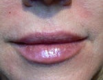 Lips & NL immediately after