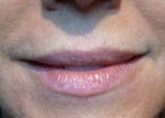 Lips & NL Before