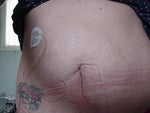 Before- Type 1 Diabetic