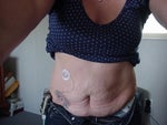 Before- Type 1 Diabetic