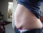 Before- Type 1 Diabetic