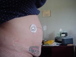 Before- Type 1 Diabetic