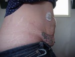 Before- Type 1 Diabetic