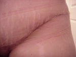 24 days after - Type 1 Diabetic