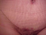 24 days after - Type 1 Diabetic