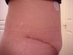 24 days after - Type 1 Diabetic