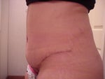 24 days after - Type 1 Diabetic