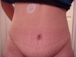 24 days after - Type 1 Diabetic