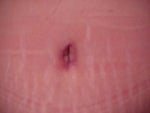 24 days after - Type 1 Diabetic
